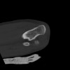 SPORK, NICO - 22.03.1976 - 02.08.2022 - CT obere Extremität - 18:02:23
